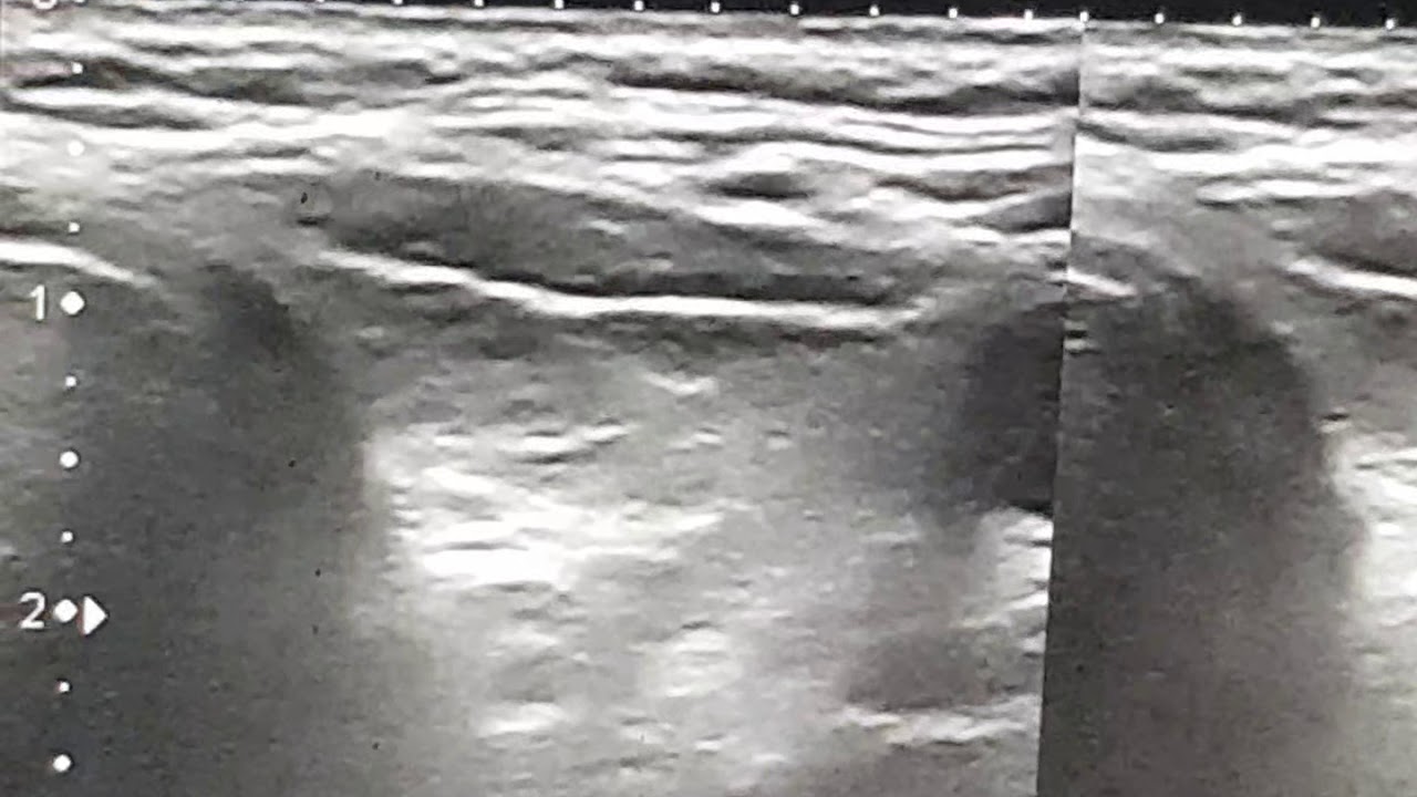 UlTRAZVUCNI NALAZ NODUSA STITASTE ZLEZDE