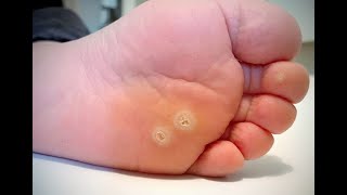 Laser Removal of a Plantar Wart