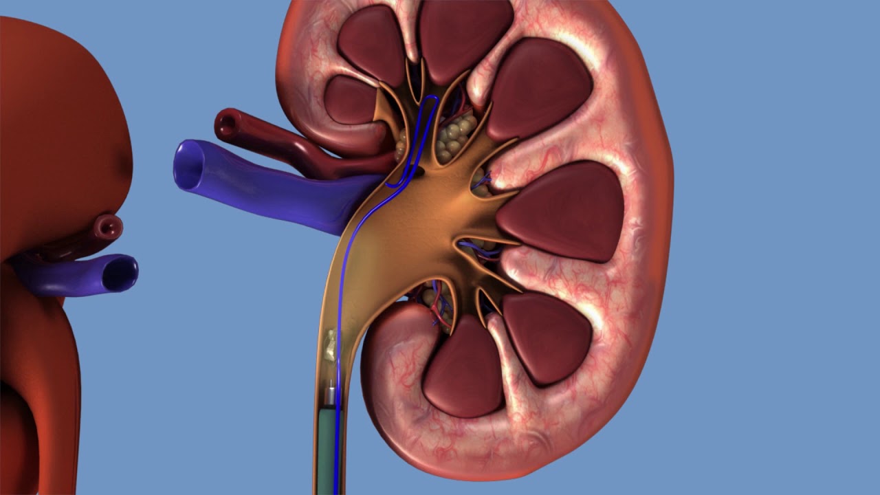 Уретероскопия - удаление камня мочеточника через его просвет. - YouTube