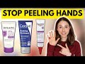 How to STOP SKIN PEELING ON THE HANDS & FEET 🤔 Dermatologist @DrDrayzday