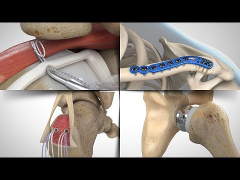 Still from the Orthopedic Demo Reel animation