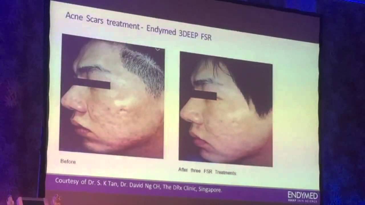 Optimal Treatment of Acne Scars in Asian and Dark Skin Types YouTube
