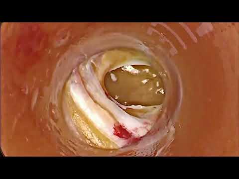 جراحی اسلیو معده