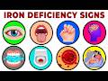 11 Signs of Iron Deficiency You Can See | Health Explained