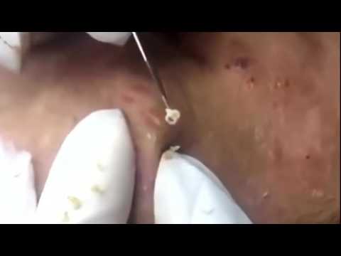 Acne And Blackhead Removal On Eyes, Nose, Cheek and Chin With Relaxing Guitar And Piano Music
