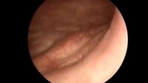 Cosa vuol dire sclerosi del collo vescicale?