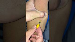 24G IV Cannula Explained in 60 Seconds! #drnakash2001