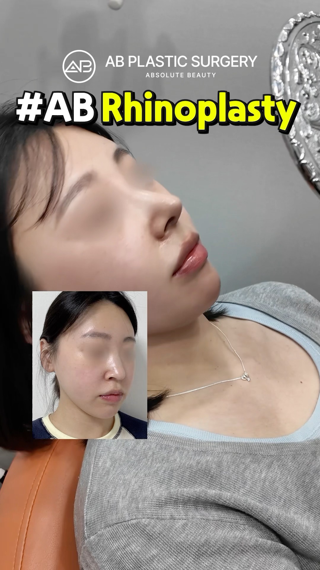 rhinoplasty review in Korea #koreanplasticsurgery