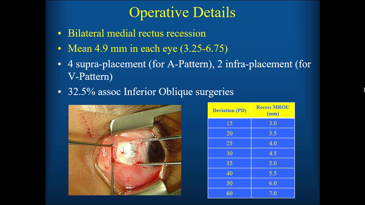 A New Protocol for Surgical Treatment of Residual Accommodative Esotropia - Dr. Del Monte A New Protocol for Surgical Treatment of Residual Accommodative Esotropia - Dr. Del Monte