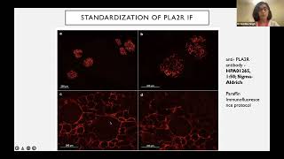 Membranous Nephropathy -WIN India Session 22-04-2022