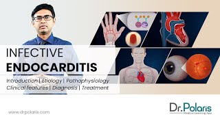 INFECTIVE ENDOCARDITIS - Etiology, Pathophysiology, Clinical Features, Management - (Animated)
