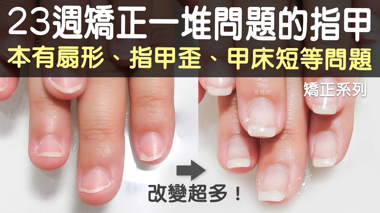 這真的是同一個人的手嗎 23週的矯正原本有扇形 指甲歪 甲床短等問題 Youtube