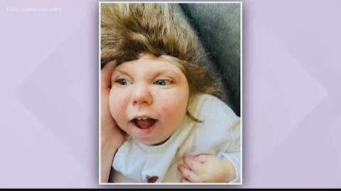5-year-old boy born without most of his brain dies...