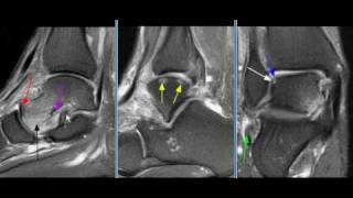 MRI Ankle Case 30