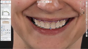 3Shape Smile Design