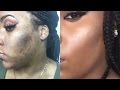 HOW TO COVER ACNE SCARS & HYPERPIGMENTATION