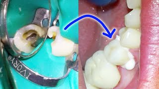 Full Root Canal & Crown Procedure w/ Post & Build-Up Placement Process. Dental Treatment On A Molar!