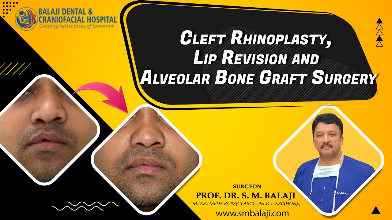 Cleft Rhinoplasty, Lip Revision and Alveolar Bone Graft Surgery - YouTube