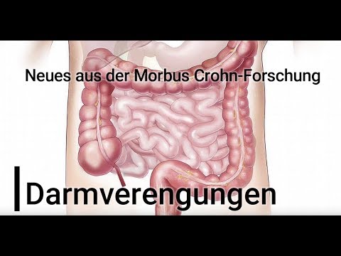 "Darmverengungen" - Neues aus der Morbus Crohn-Forschung