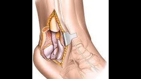 Osteotomy Ankle CPT code - simplify medical coding