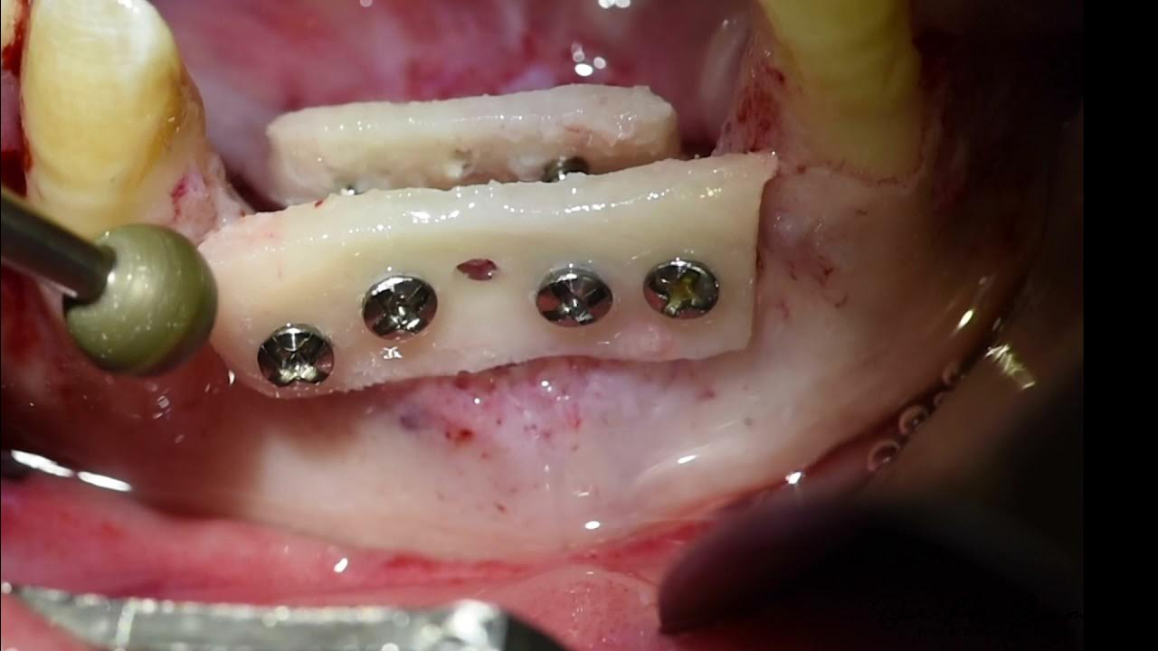 Double khoury technique for Vertical & Horizontal ridge augmentation