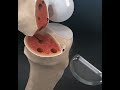 Unilateral knee replacement unicompartmental knee replacemen uka 3danimation  education 3d