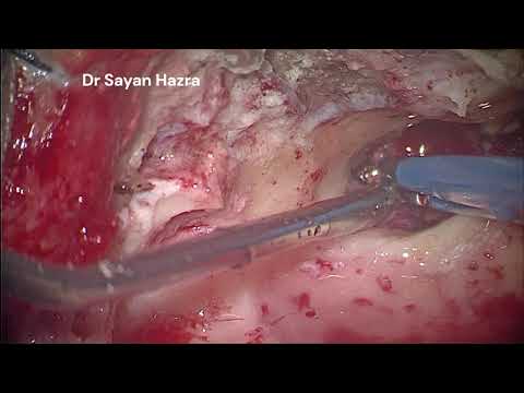 Left Glomus Tympanicum Dr Sayan Hazra