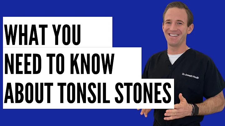 ASK DR. H - What You Need to Know About Tonsil Stones