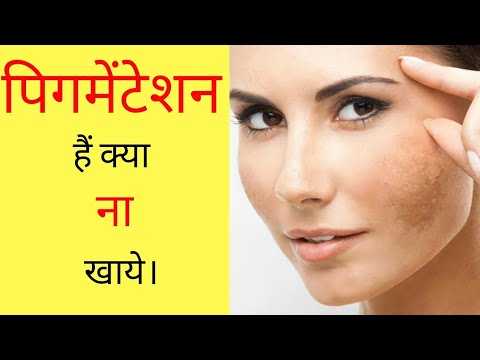 पिगमेंटेशन है क्या ना खाये।  by Dr. Manoj Das