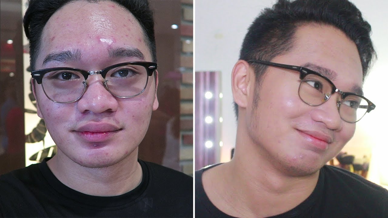 acne treatment tagalog
