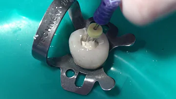 Como restaurar dente Deciduo?
