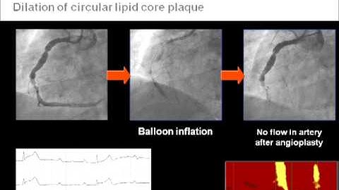 Detection of Lipid-Core Plaques by Intracoronary NIRS Identifies High Risk of Peri-Procedural MI