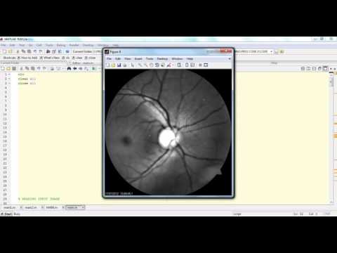 GLAUCOMA DETECTION USING ARTIFICIAL NEURAL NETWORKS||MATLAB Ieee Projects Bangalore