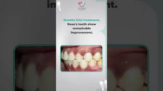 Before After Rose Orthodontic Journey
