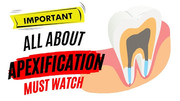 Apexification Made Easy