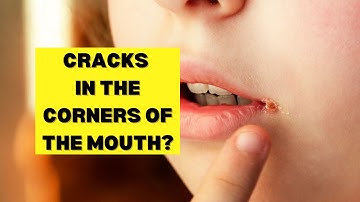 Angular Cheilitis | Why It Occurs And How To Cure It