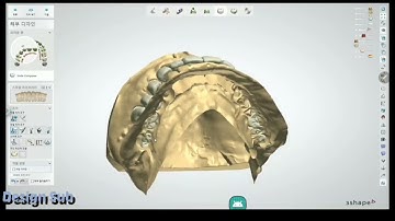 3shape design (implant case upper full arch)