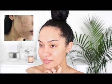How I&#;m Getting Rid Of Acne + My Skincare Products