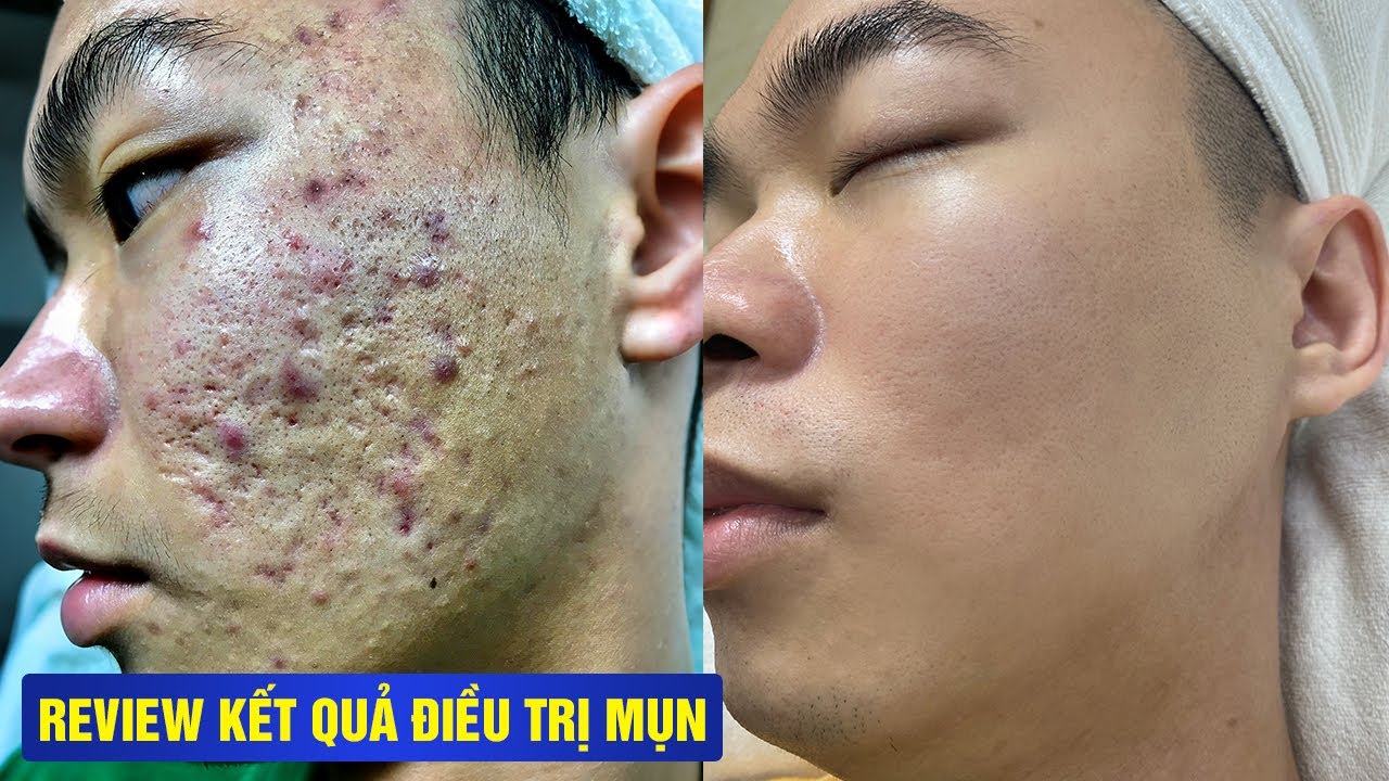 TRỊ MỤN 1 LẦN – DA ĐẸP SUỐT 6 NĂM, KHÔNG TÁI PHÁT - TẠI PHÒNG KHÁM DA LIỄU HHV CLINIC.
