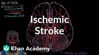 Ischemic stroke | Circulatory System and Disease | NCLEX-RN | Khan Academy