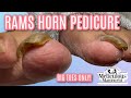 👣Big Toes Only - RAM'S HORN TOENAILS CAUSE INGROWN TOENAIL PAIN👣