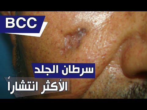 أشهر أنواع سرطانات الجلد .. سرطان الخلايا القاعدية Basal Cell Carcinoma