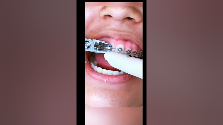 RETIRAGE D'UN APPAREIL DENTAIRE !🦋 #trend #pourtoi #appareildentaire #doctor #tiktokviral #abonnetoi
