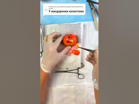 колостома - YouTube