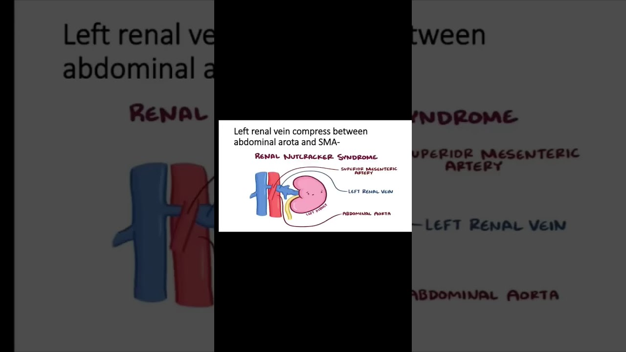 What Is Nutcracker Syndrome