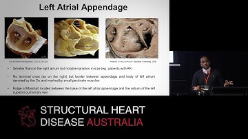 Left atrial anatomy - All the nooks & crannies - Dr Sean Lal