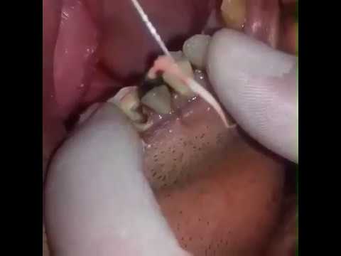 Video: Gedurende endodontiese behandeling word die pulpkanale met besproei?