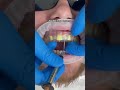 Predesigned composite veneers technique dentist shorts