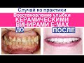 Восстановление красоты улыбки керамическими винирами E-max, восстановление зуба методом Build-up