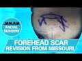 Part 1 forehead scar revision from missouri  dr tanveer janjua  new jersey